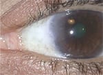post20pterygium20sx20pic post20pterygium20sx20pic