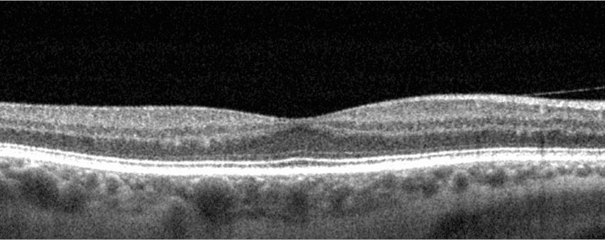 normal retina exam feathre macula