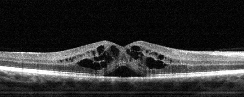 unhealthyretina oct unhealthyretina oct