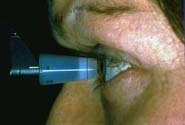 1774301451_glaucoma-1 glaucoma 1