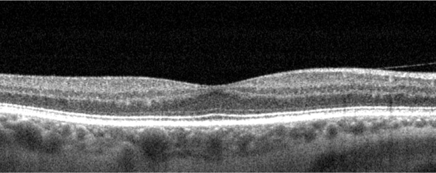 1774301475_healthyretina-oct-1 healthyretina oct 1